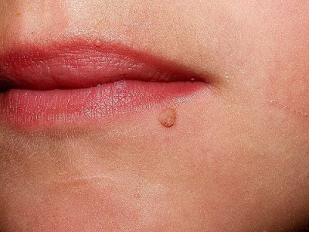 Remedios naturales para eliminar las verrugas planas