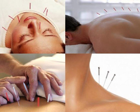 beneficios de la Acupuntura