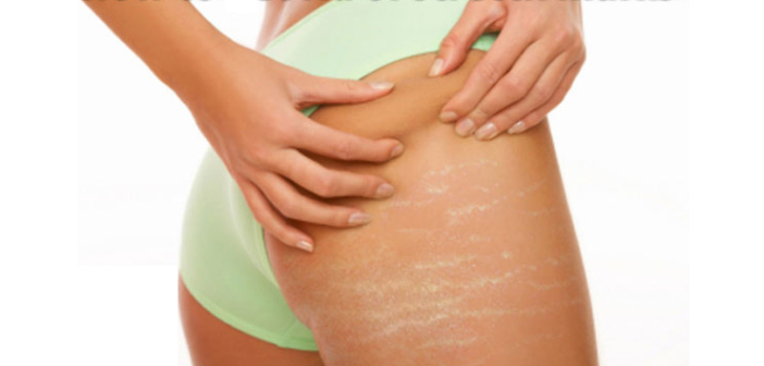 como combatir las estrías