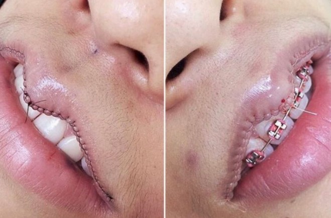 Cirugía de reducción de labios