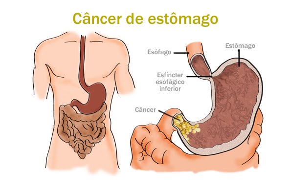 cáncer de estómago