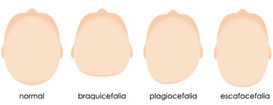deformidades craneales deformidades craneales